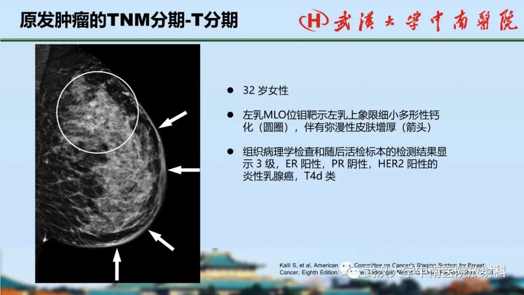 影像PPT - 【PPT】乳腺癌第八版TNM分期解读—影像科医生的责任和挑战-22