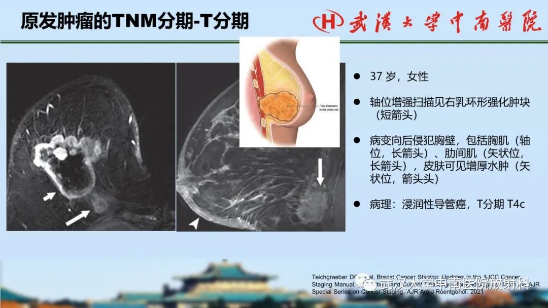 影像PPT - 【PPT】乳腺癌第八版TNM分期解读—影像科医生的责任和挑战-20