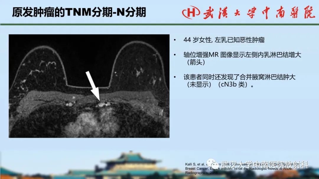 影像PPT - 【PPT】乳腺癌第八版TNM分期解读—影像科医生的责任和挑战-28