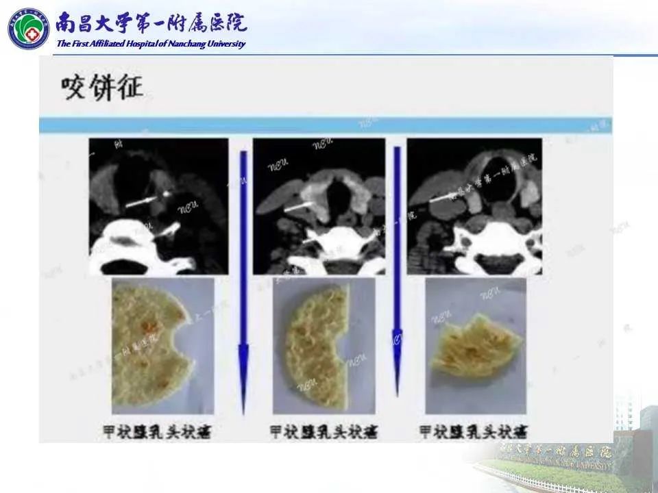 影像PPT - 【PPT】常见甲状腺结节的CT鉴别诊断-10