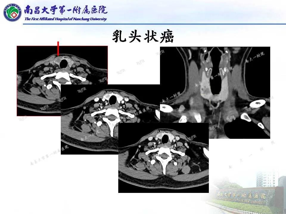 影像PPT - 【PPT】常见甲状腺结节的CT鉴别诊断-11
