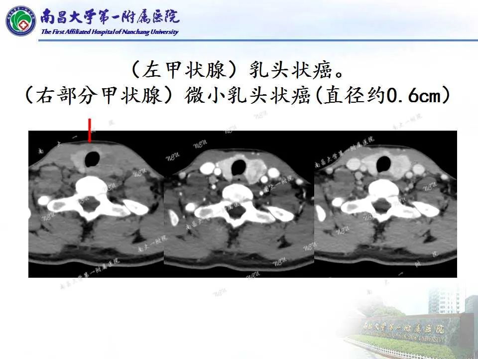 影像PPT - 【PPT】常见甲状腺结节的CT鉴别诊断-13
