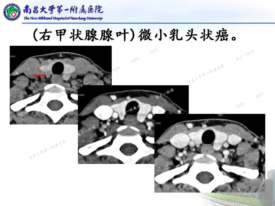 影像PPT - 【PPT】常见甲状腺结节的CT鉴别诊断-12