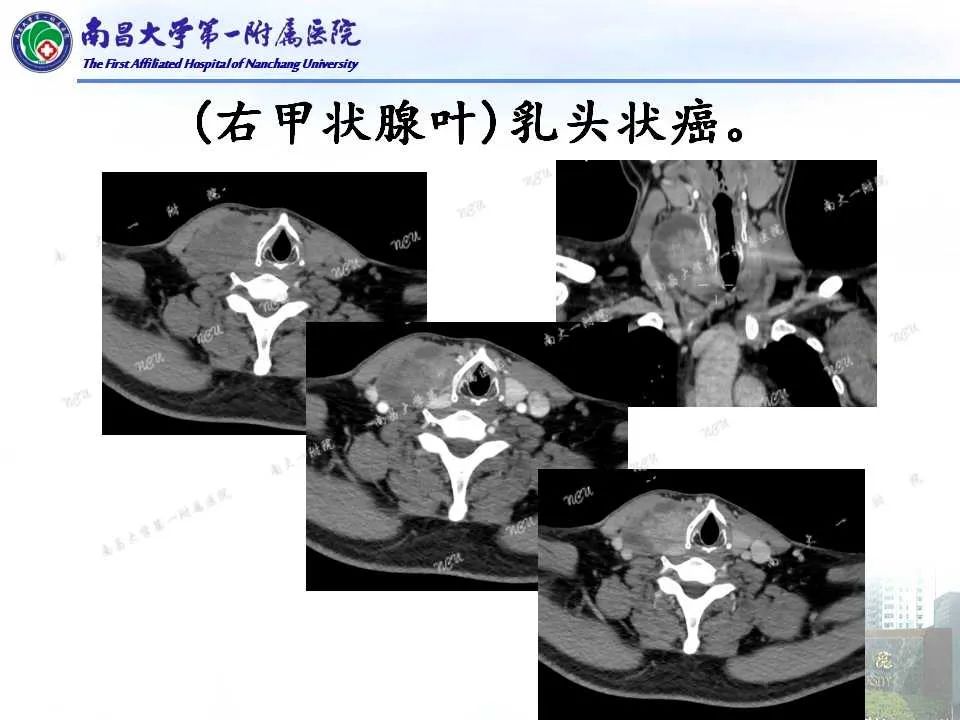 影像PPT - 【PPT】常见甲状腺结节的CT鉴别诊断-14