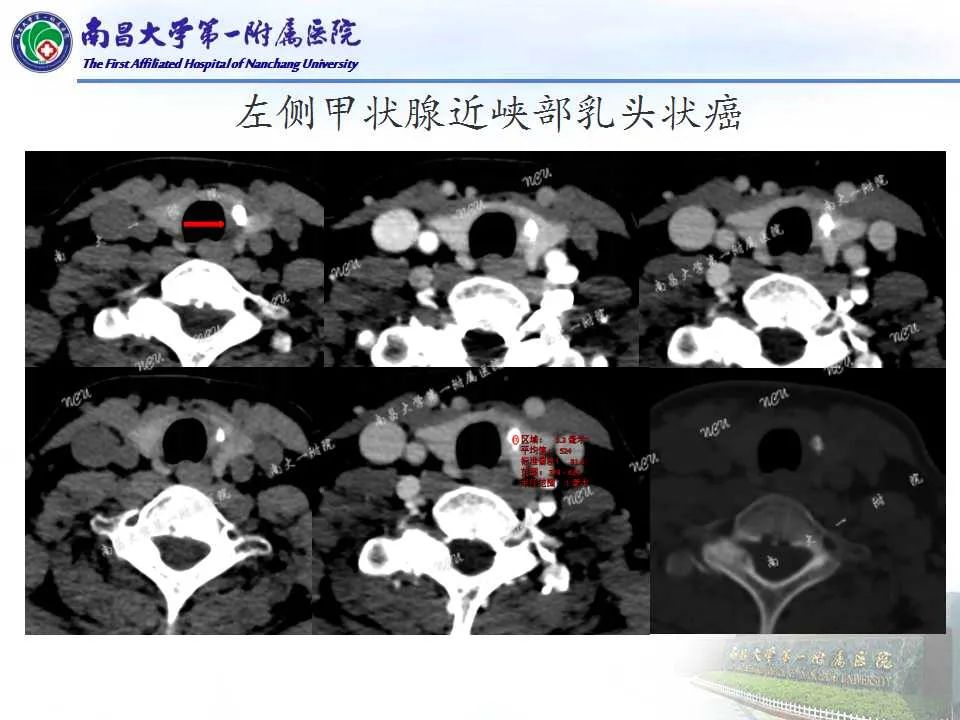 影像PPT - 【PPT】常见甲状腺结节的CT鉴别诊断-15