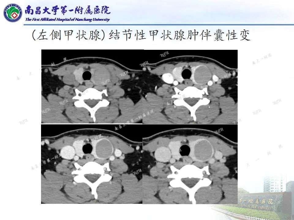 影像PPT - 【PPT】常见甲状腺结节的CT鉴别诊断-18