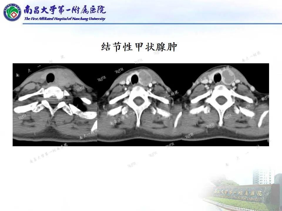 影像PPT - 【PPT】常见甲状腺结节的CT鉴别诊断-19