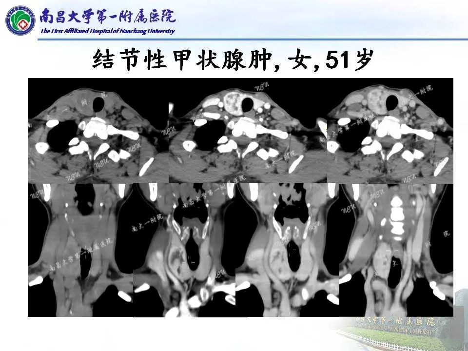 影像PPT - 【PPT】常见甲状腺结节的CT鉴别诊断-21