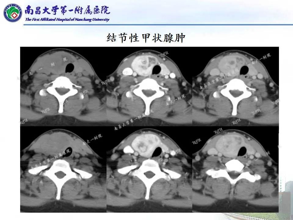 影像PPT - 【PPT】常见甲状腺结节的CT鉴别诊断-20