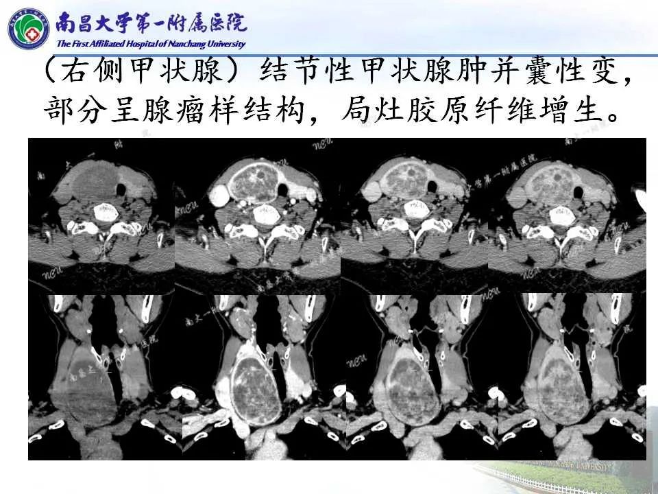 影像PPT - 【PPT】常见甲状腺结节的CT鉴别诊断-22