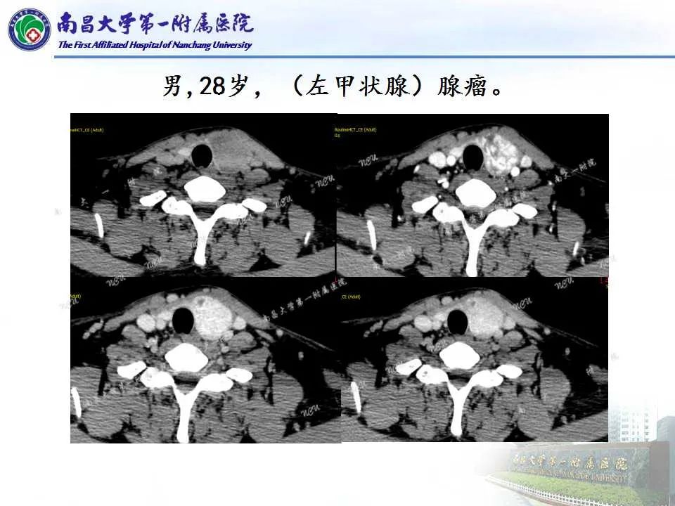 影像PPT - 【PPT】常见甲状腺结节的CT鉴别诊断-26