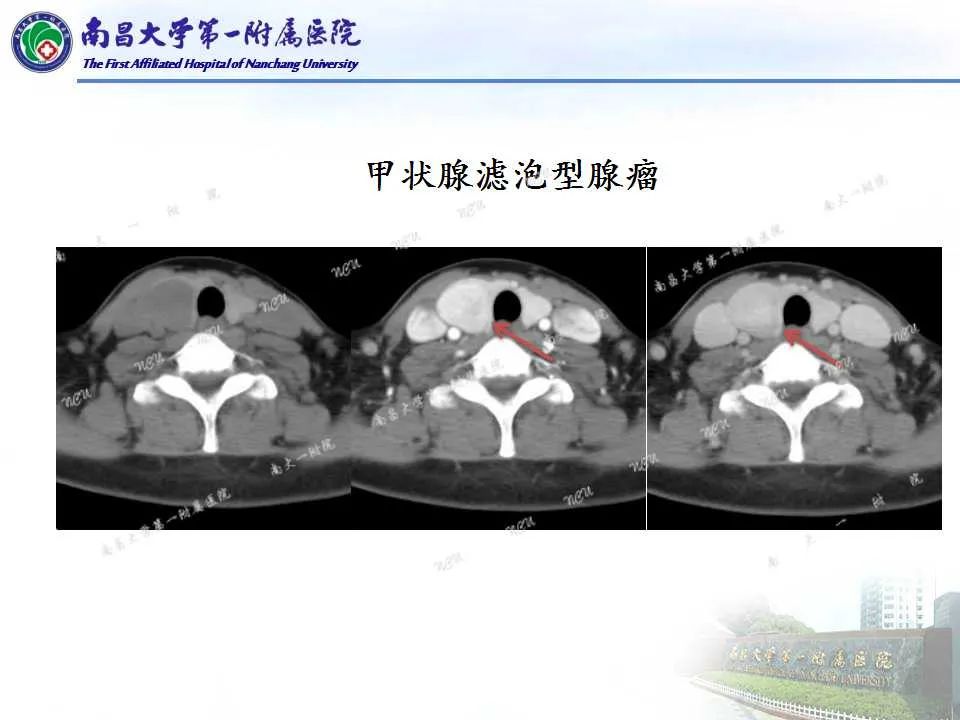 影像PPT - 【PPT】常见甲状腺结节的CT鉴别诊断-25