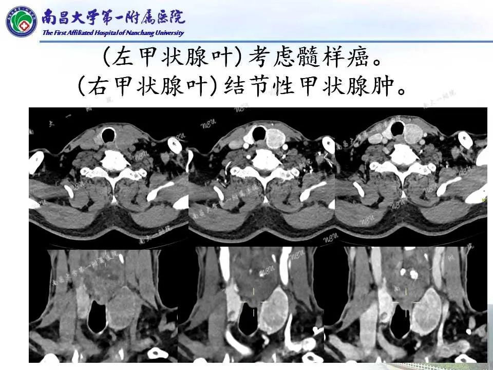 影像PPT - 【PPT】常见甲状腺结节的CT鉴别诊断-29