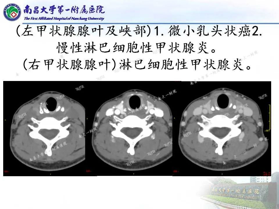 影像PPT - 【PPT】常见甲状腺结节的CT鉴别诊断-33