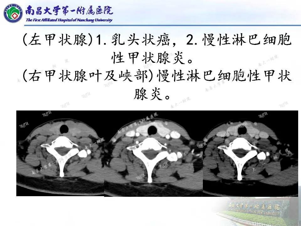 影像PPT - 【PPT】常见甲状腺结节的CT鉴别诊断-34