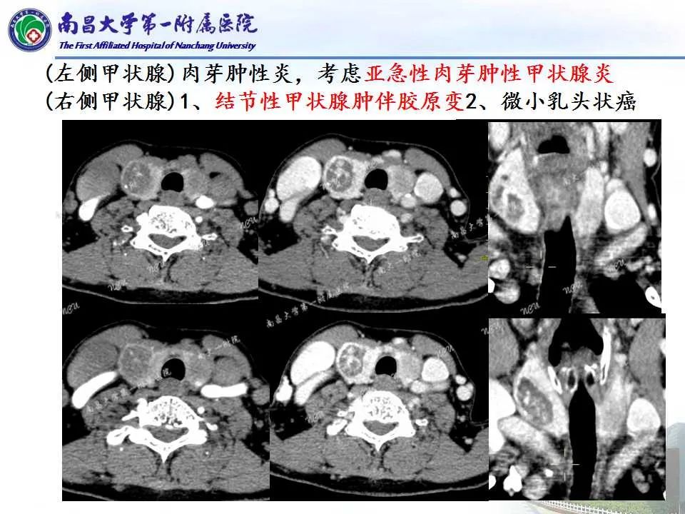 影像PPT - 【PPT】常见甲状腺结节的CT鉴别诊断-37