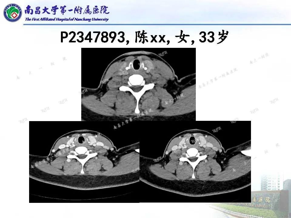 影像PPT - 【PPT】常见甲状腺结节的CT鉴别诊断-39