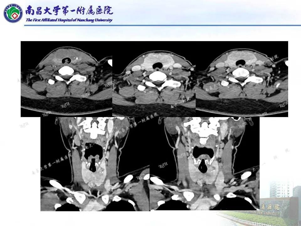 影像PPT - 【PPT】常见甲状腺结节的CT鉴别诊断-40