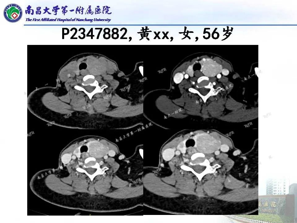 影像PPT - 【PPT】常见甲状腺结节的CT鉴别诊断-43