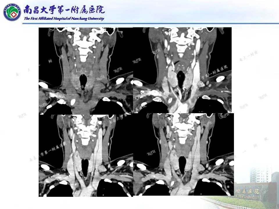 影像PPT - 【PPT】常见甲状腺结节的CT鉴别诊断-41