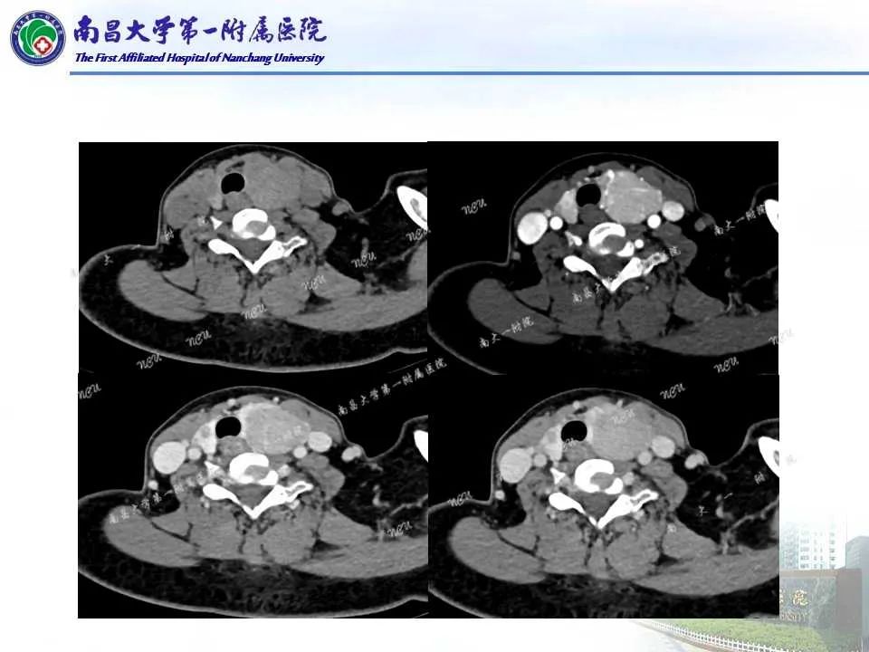 影像PPT - 【PPT】常见甲状腺结节的CT鉴别诊断-44