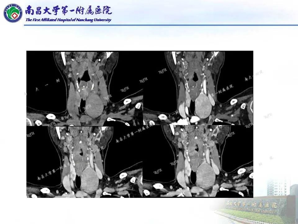 影像PPT - 【PPT】常见甲状腺结节的CT鉴别诊断-45