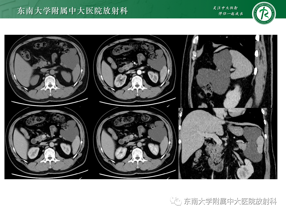 影像PPT - 【PPT】原发性腹膜后囊性病变-2