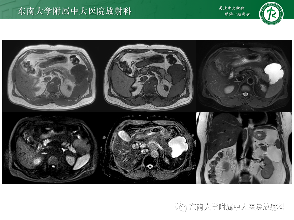 影像PPT - 【PPT】原发性腹膜后囊性病变-4