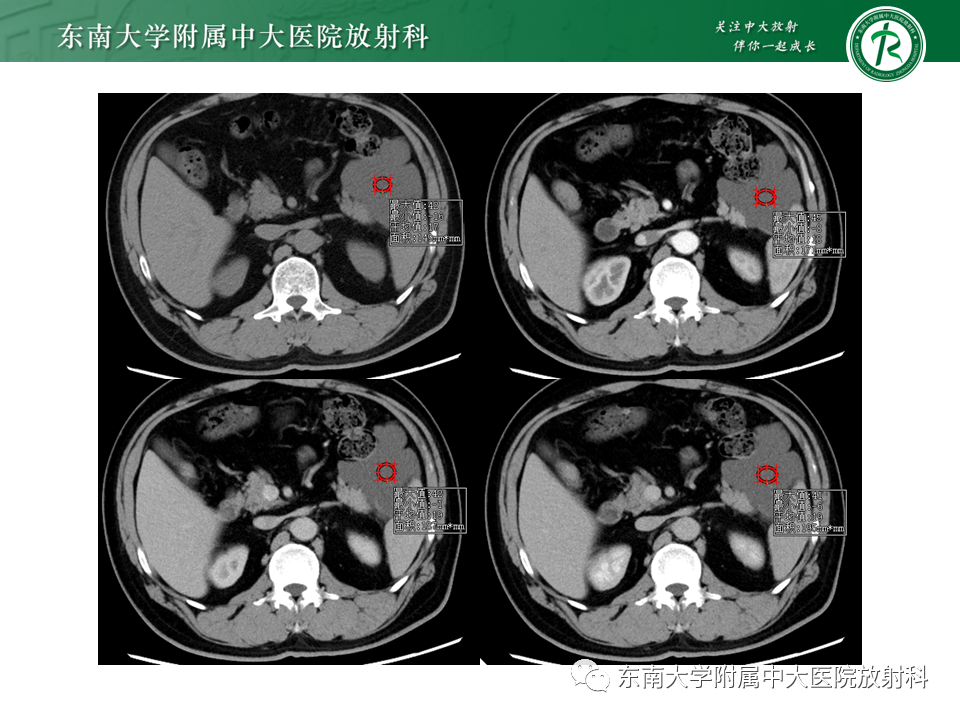 影像PPT - 【PPT】原发性腹膜后囊性病变-3