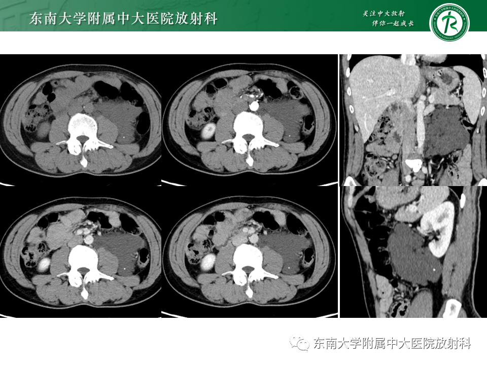 影像PPT - 【PPT】原发性腹膜后囊性病变-6