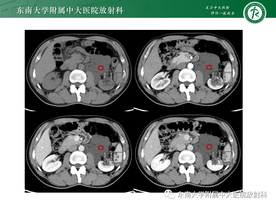 影像PPT - 【PPT】原发性腹膜后囊性病变-7