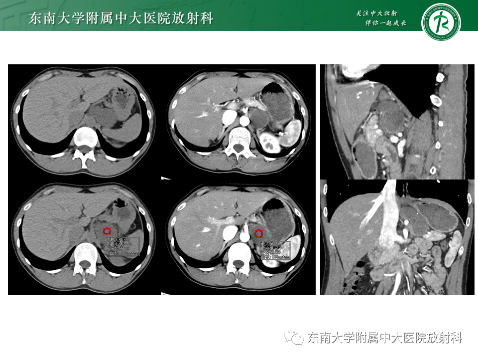 影像PPT - 【PPT】原发性腹膜后囊性病变-9
