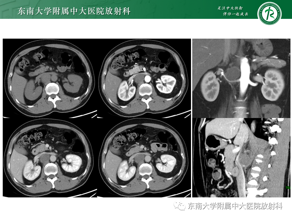 影像PPT - 【PPT】原发性腹膜后囊性病变-11