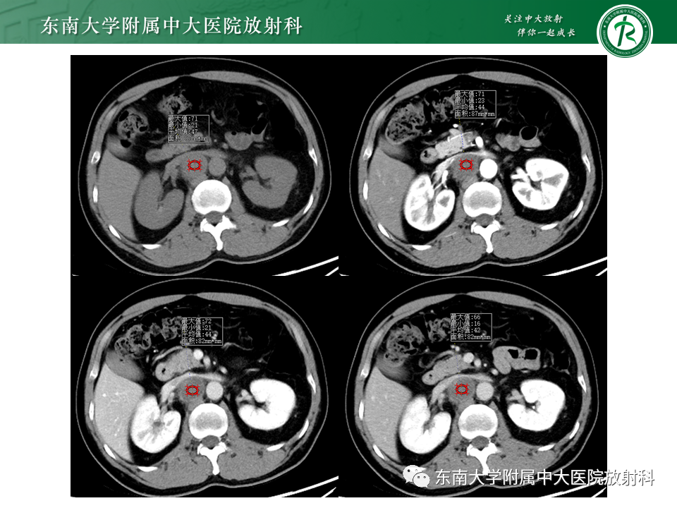 影像PPT - 【PPT】原发性腹膜后囊性病变-12