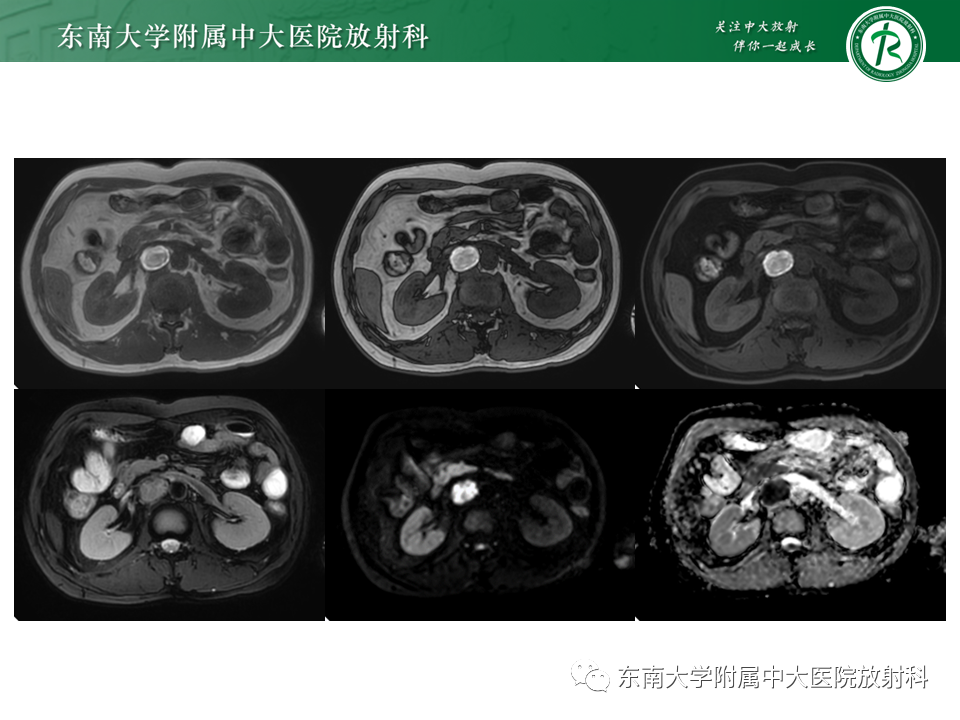 影像PPT - 【PPT】原发性腹膜后囊性病变-13