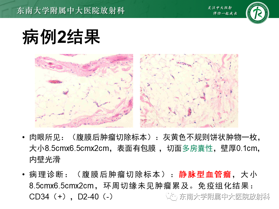 影像PPT - 【PPT】原发性腹膜后囊性病变-17