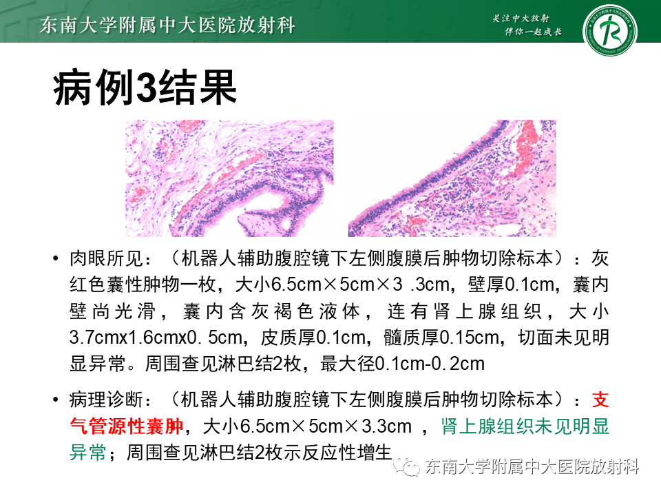 影像PPT - 【PPT】原发性腹膜后囊性病变-19