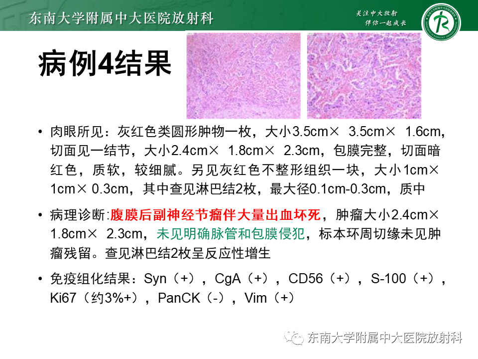影像PPT - 【PPT】原发性腹膜后囊性病变-21