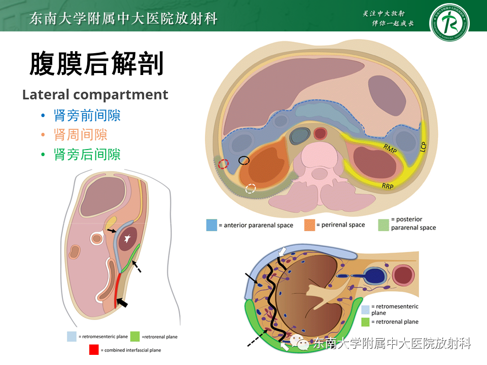 影像PPT - 【PPT】原发性腹膜后囊性病变-26