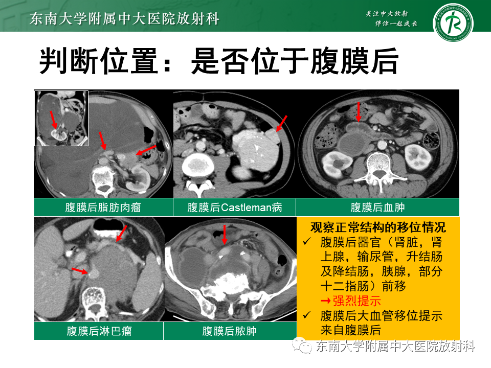 影像PPT - 【PPT】原发性腹膜后囊性病变-29
