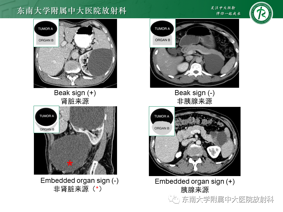 影像PPT - 【PPT】原发性腹膜后囊性病变-31