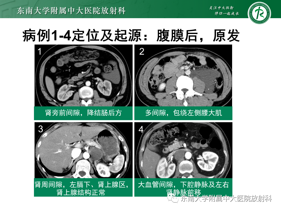 影像PPT - 【PPT】原发性腹膜后囊性病变-32