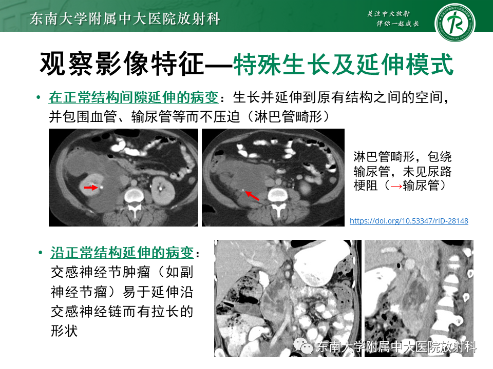 影像PPT - 【PPT】原发性腹膜后囊性病变-35
