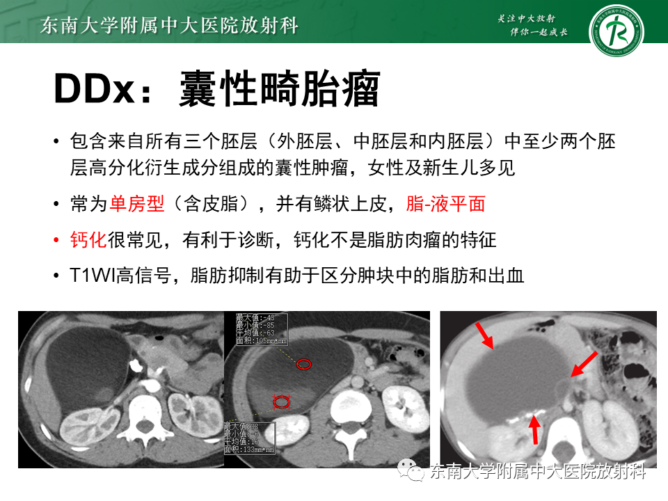 影像PPT - 【PPT】原发性腹膜后囊性病变-44
