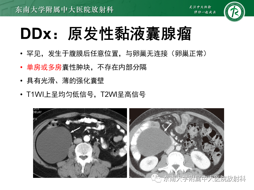 影像PPT - 【PPT】原发性腹膜后囊性病变-45