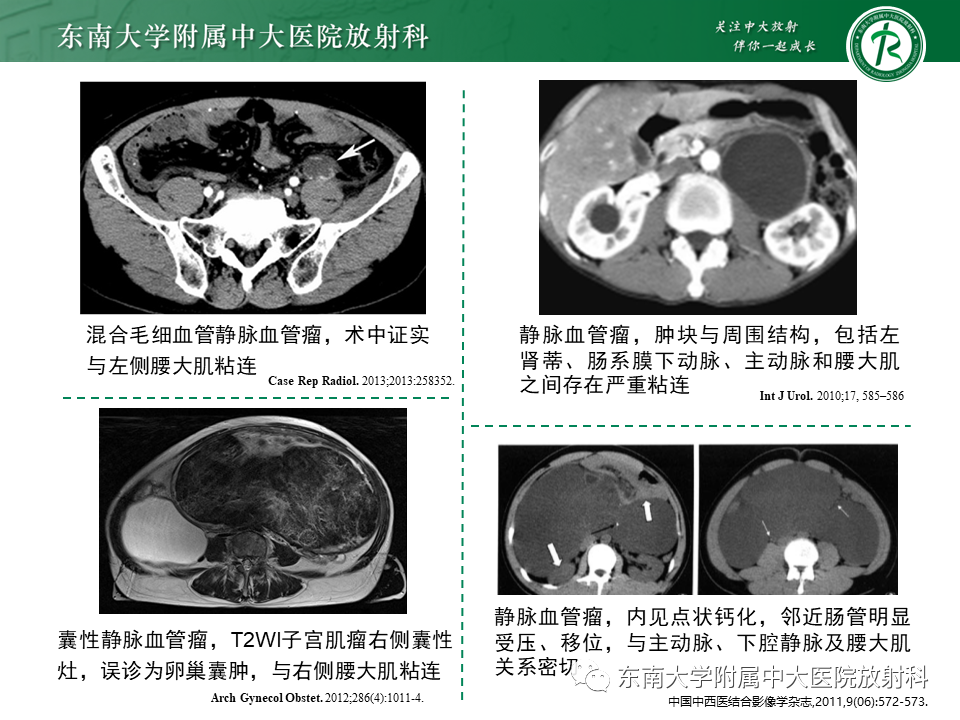 影像PPT - 【PPT】原发性腹膜后囊性病变-49