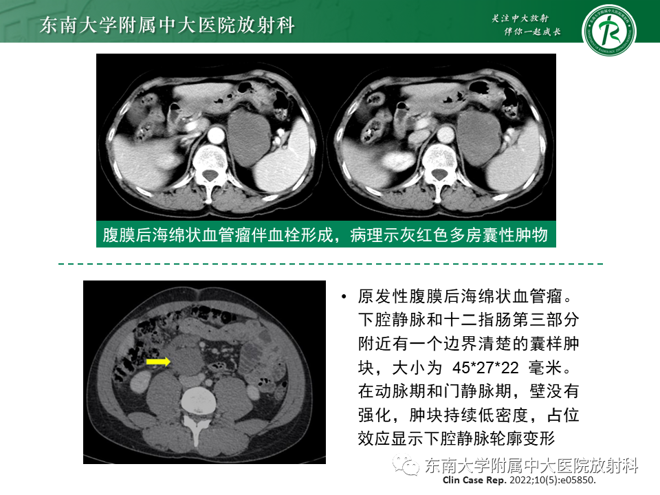 影像PPT - 【PPT】原发性腹膜后囊性病变-50