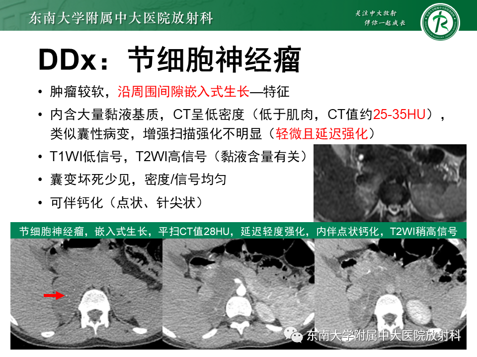 影像PPT - 【PPT】原发性腹膜后囊性病变-51