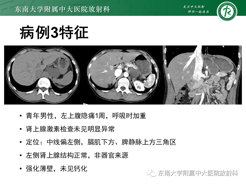 影像PPT - 【PPT】原发性腹膜后囊性病变-52