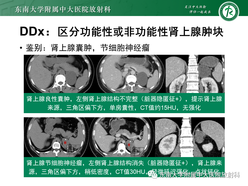 影像PPT - 【PPT】原发性腹膜后囊性病变-55